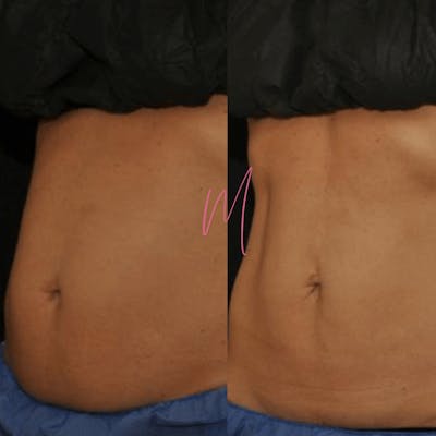 EvolveX Before & After Gallery - Patient 363650 - Image 1