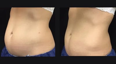 Weight Management Before & After Gallery - Patient 295634 - Image 1