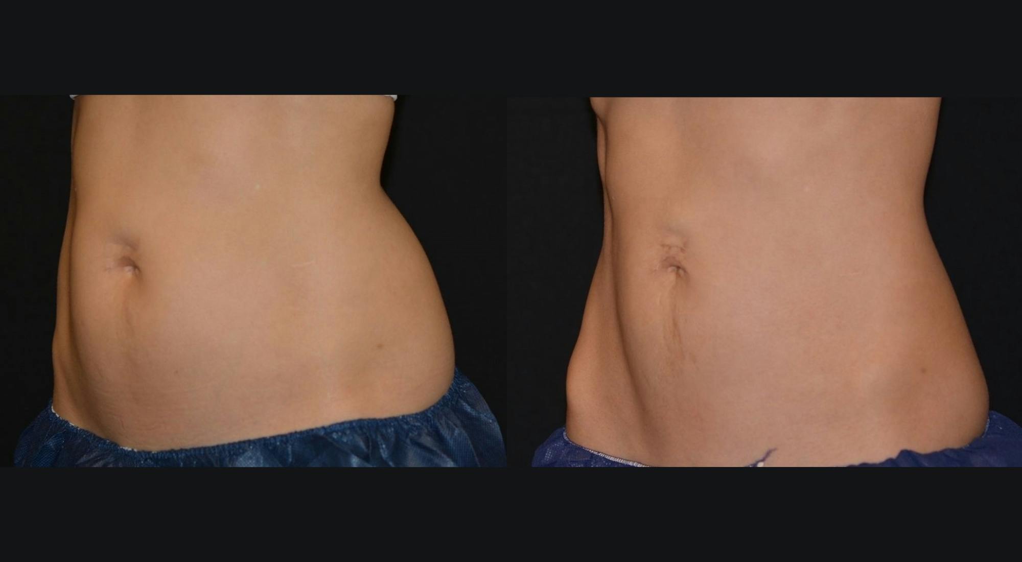 Weight Management Before & After Gallery - Patient 319922 - Image 1