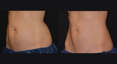 Weight Management Before & After Gallery - Patient 319922 - Image 1