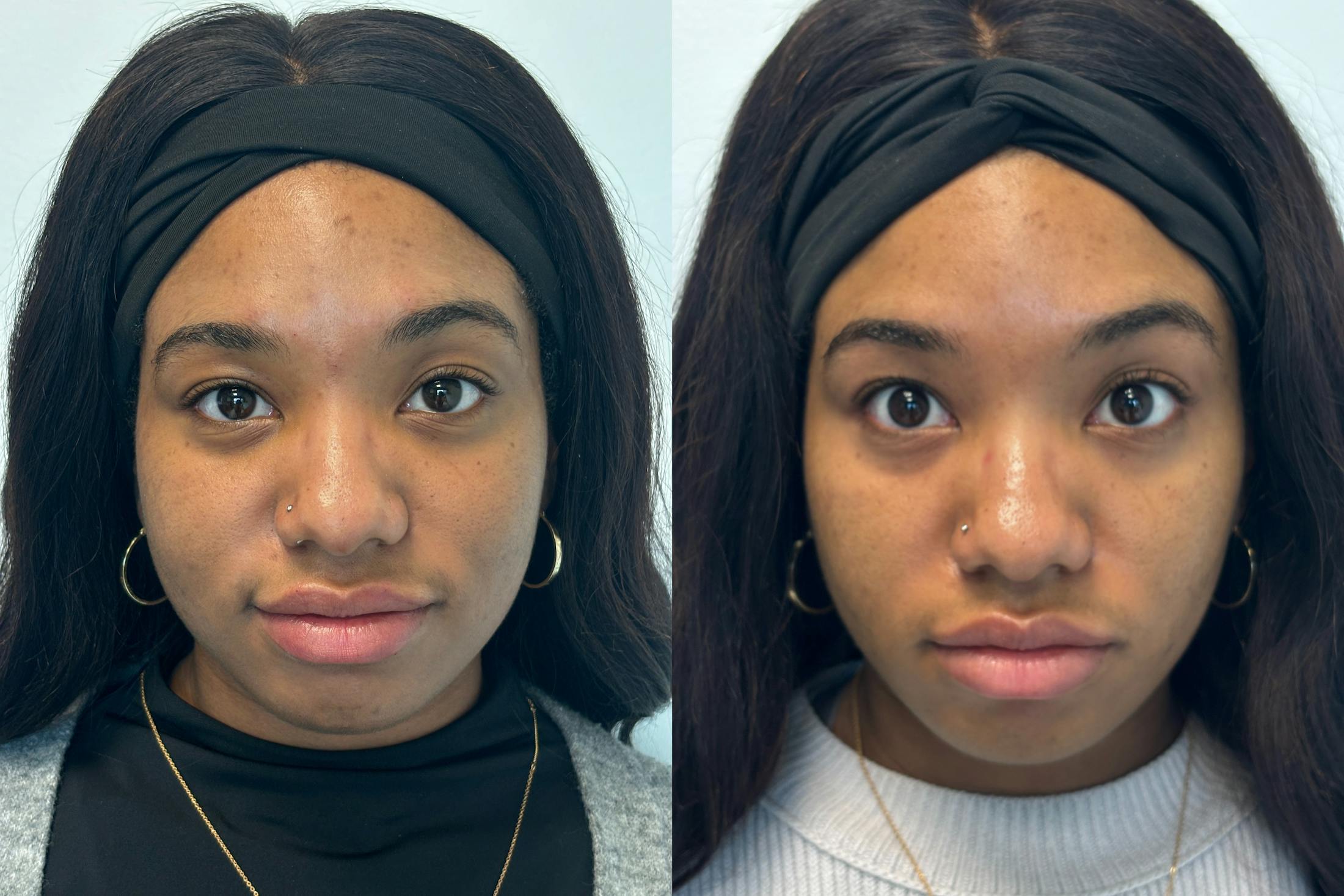 BOTOX/Dysport Before & After Gallery - Patient 345800 - Image 1