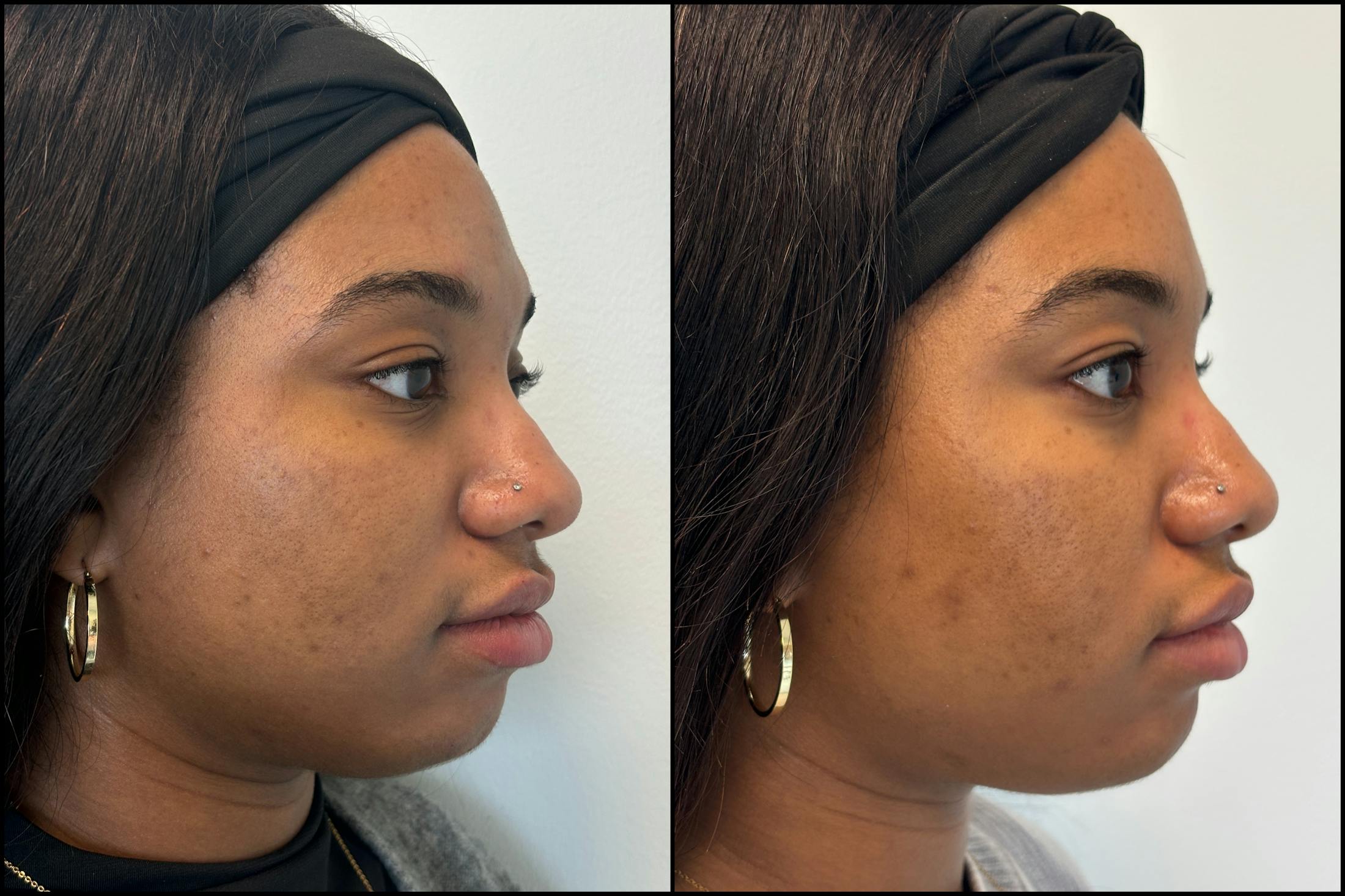 BOTOX/Dysport Before & After Gallery - Patient 345800 - Image 2