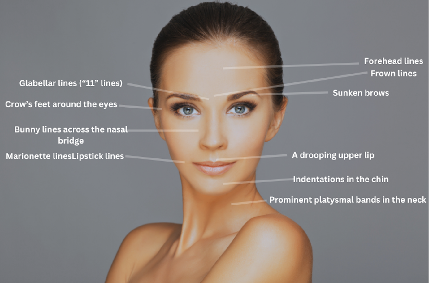 Graphic on Areas that Botox Treats