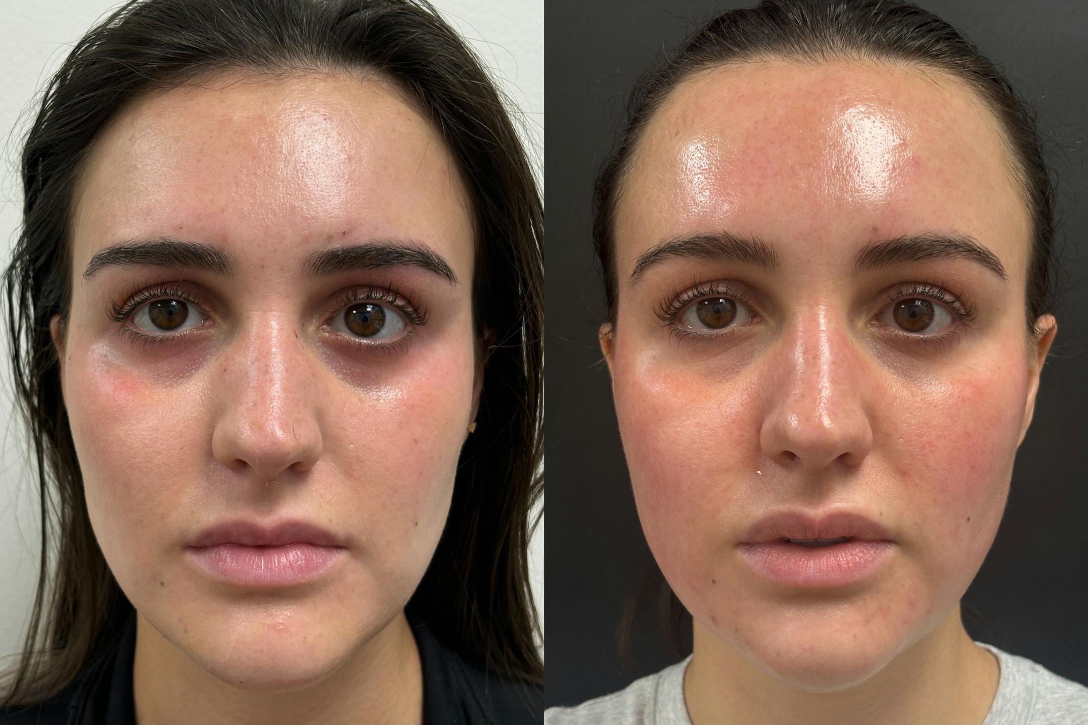BOTOX/Dysport Before & After Gallery - Patient 345800 - Image 1