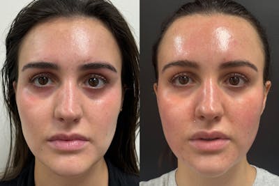 BOTOX/Dysport Before & After Gallery - Patient 345800 - Image 1