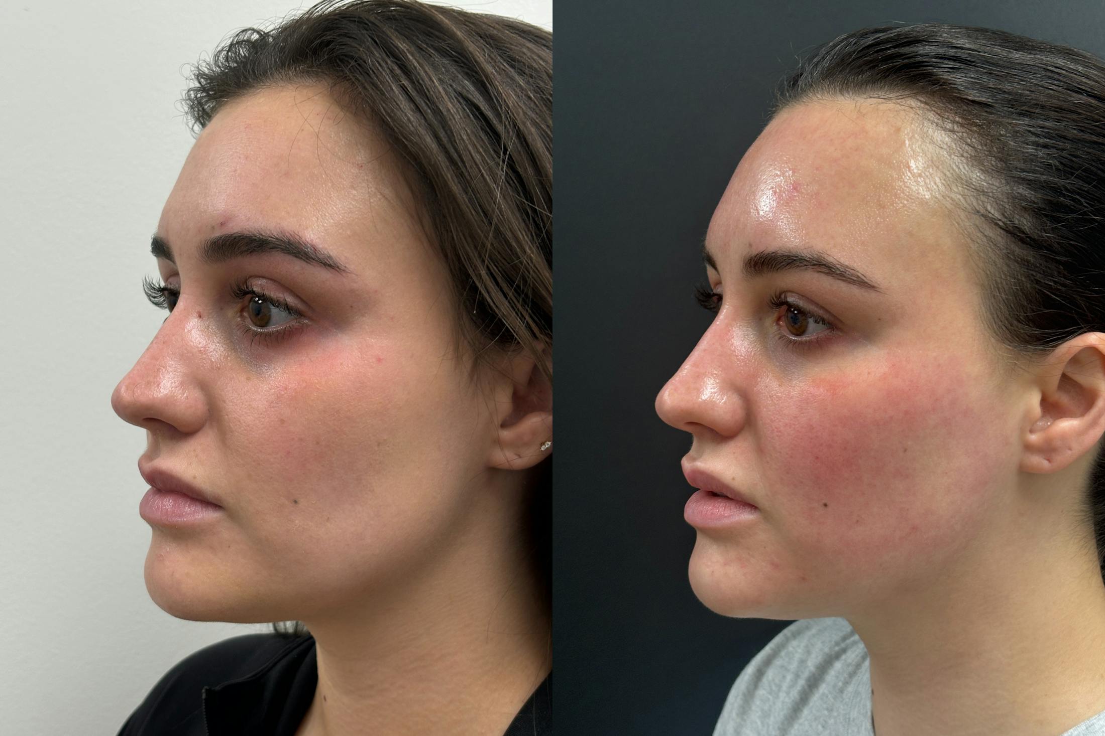 BOTOX/Dysport Before & After Gallery - Patient 345800 - Image 2