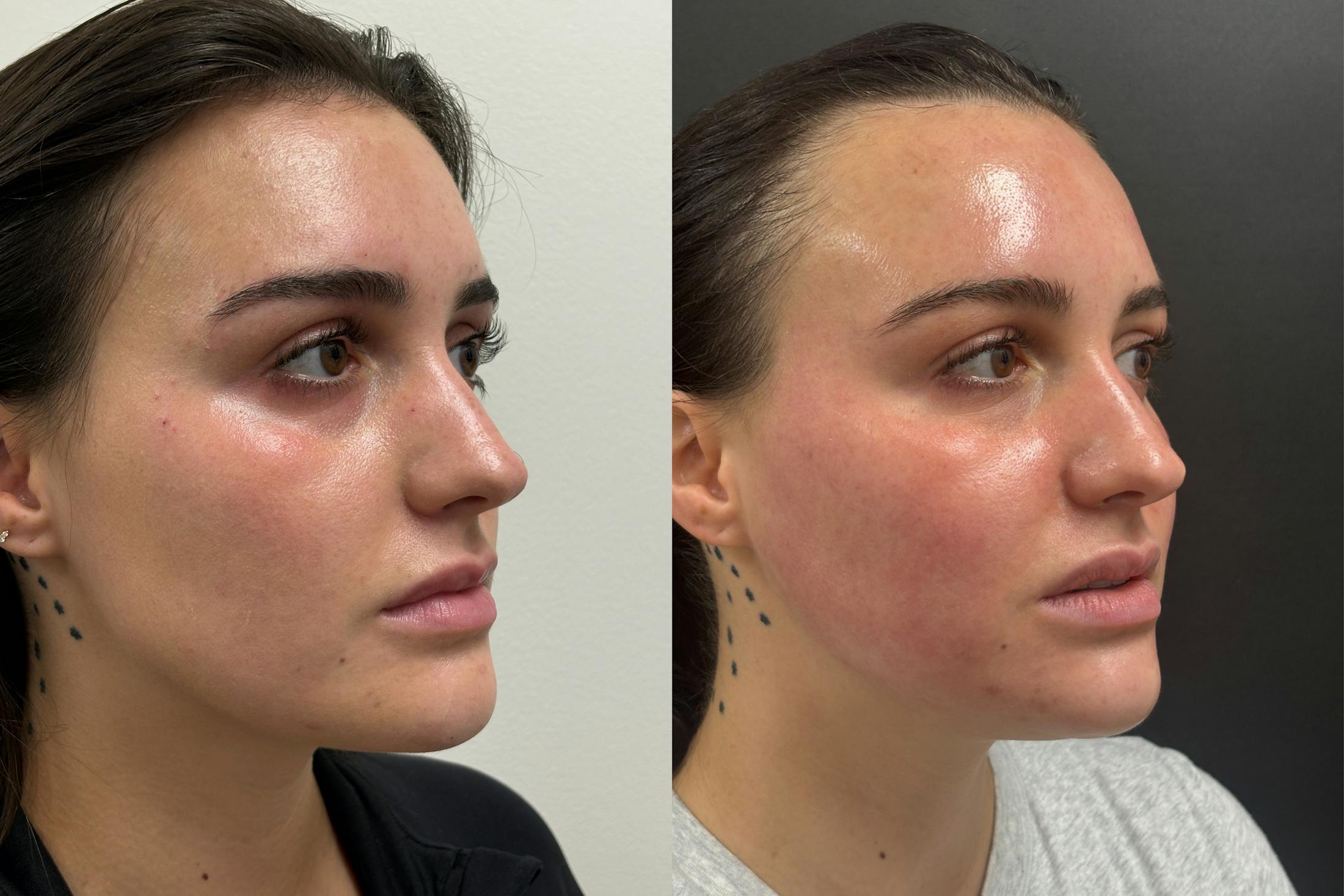 BOTOX/Dysport Before & After Gallery - Patient 345800 - Image 3