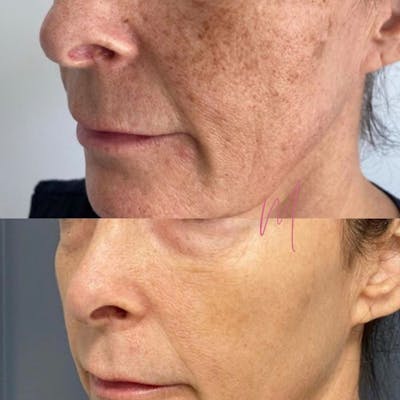 Lumecca IPL Before & After Gallery - Patient 146540 - Image 1