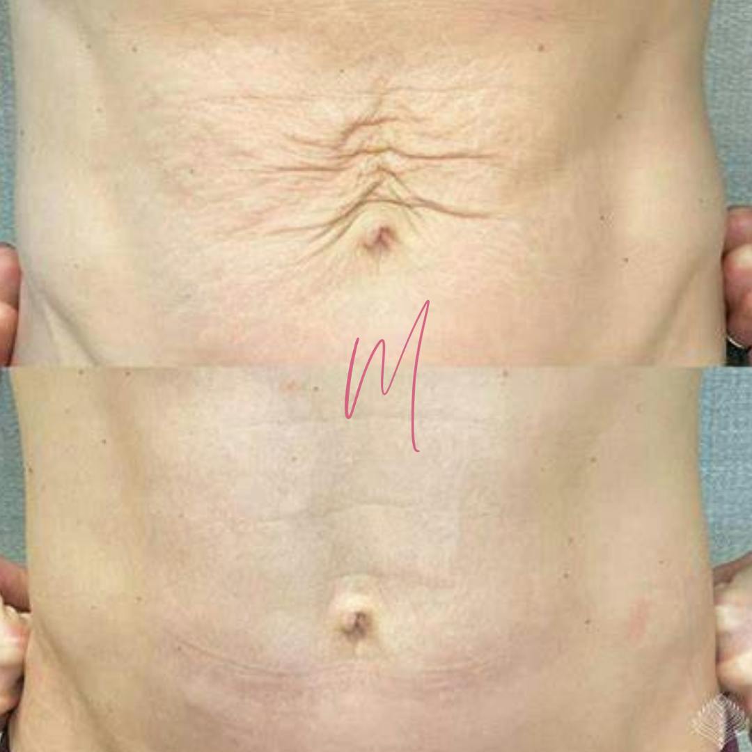 Morpheus8 for Body Before & After Gallery - Patient 100616 - Image 1