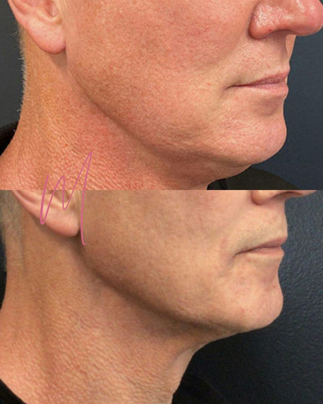 Morpheus8 Before & After Gallery - Patient 920703 - Image 1