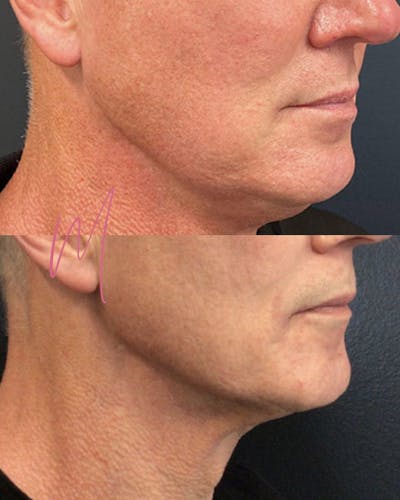 Morpheus8 Before & After Gallery - Patient 920703 - Image 1