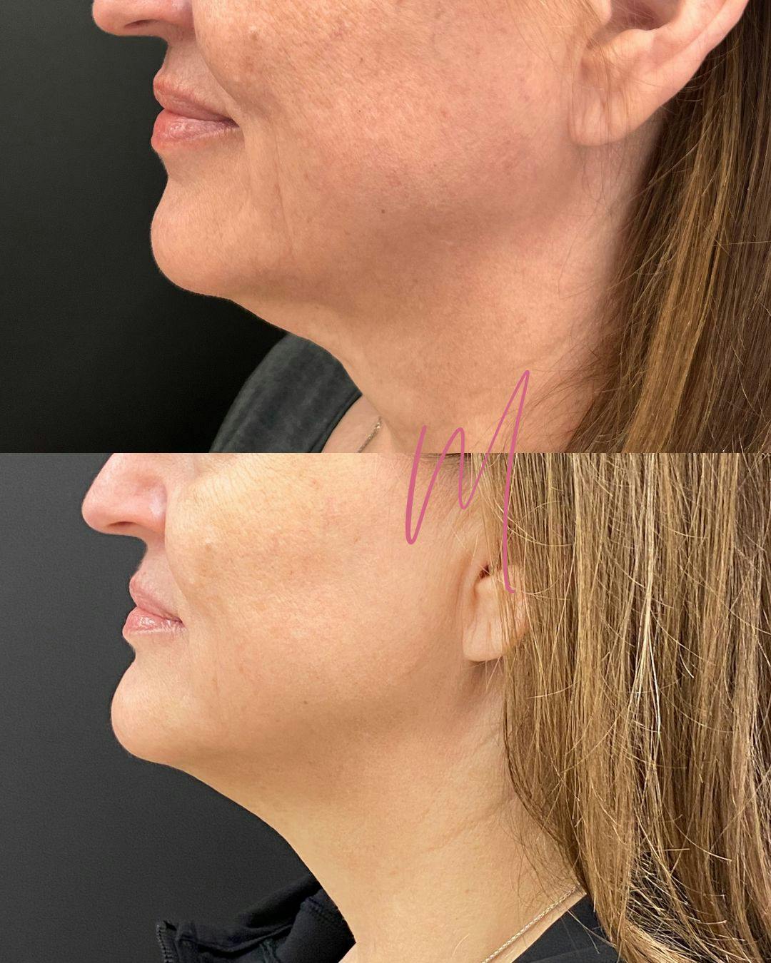Morpheus8 Before & After Gallery - Patient 419287 - Image 1