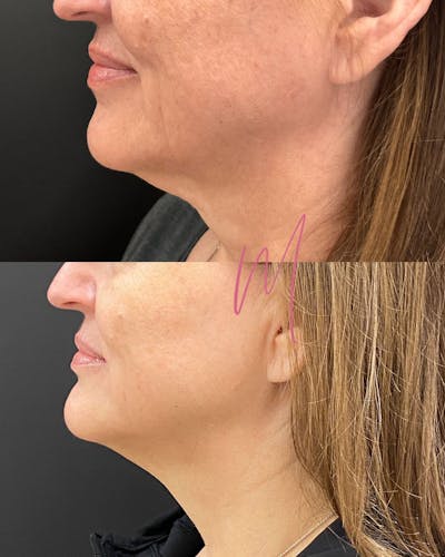 Morpheus8 Before & After Gallery - Patient 419287 - Image 1