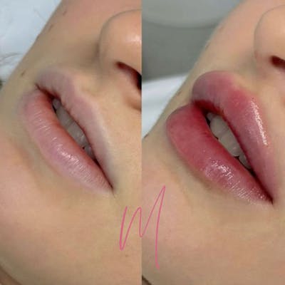 Dermal Fillers Before & After Gallery - Patient 385450 - Image 1