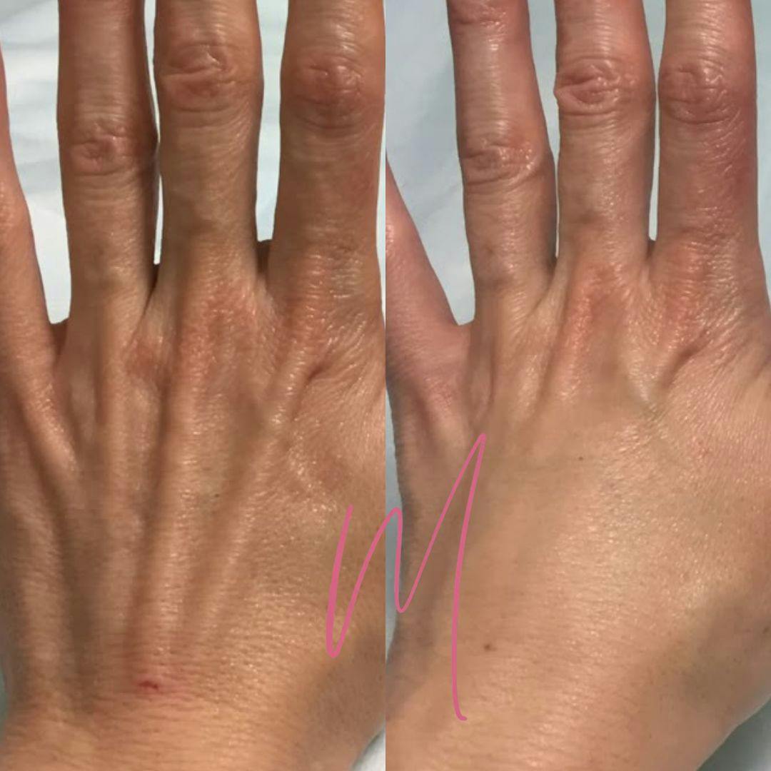 Dermal Fillers Before & After Gallery - Patient 179586 - Image 1