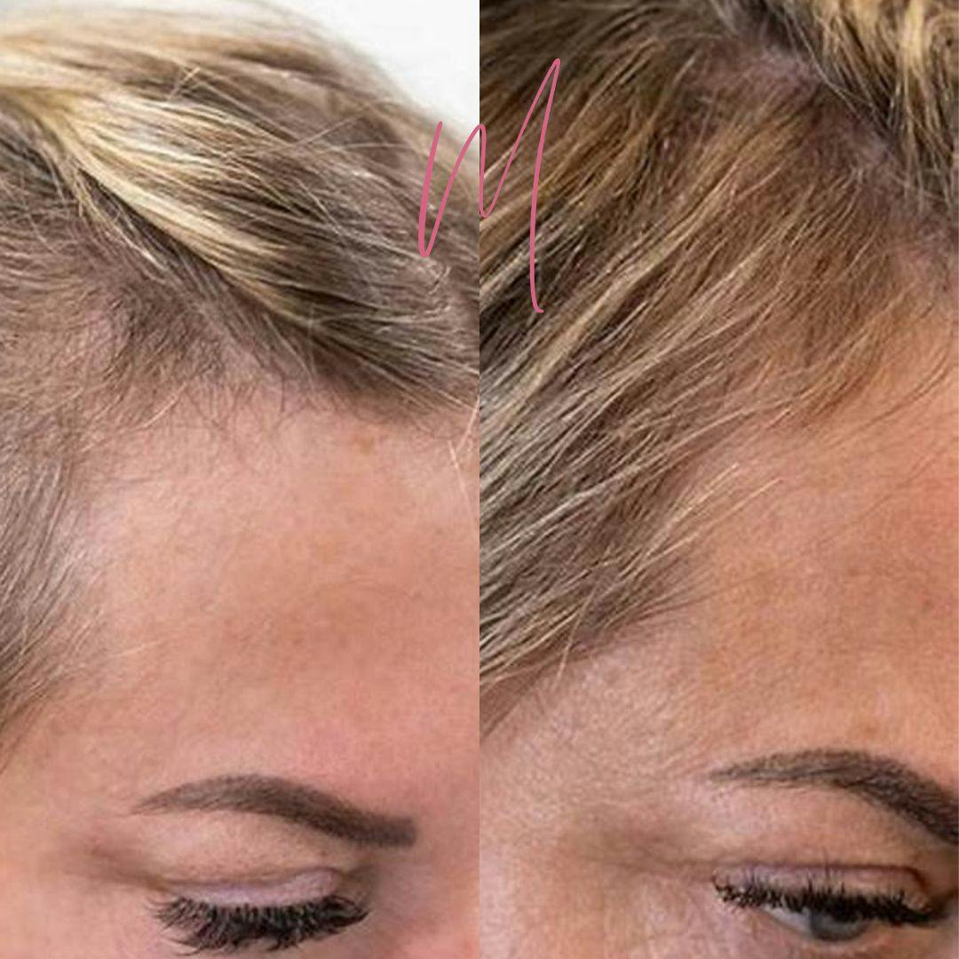 PRP Hair Restoration Before & After Gallery - Patient 100587 - Image 1