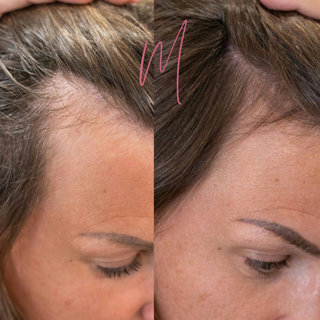 PRP Hair Restoration Before & After Gallery - Patient 278429 - Image 1