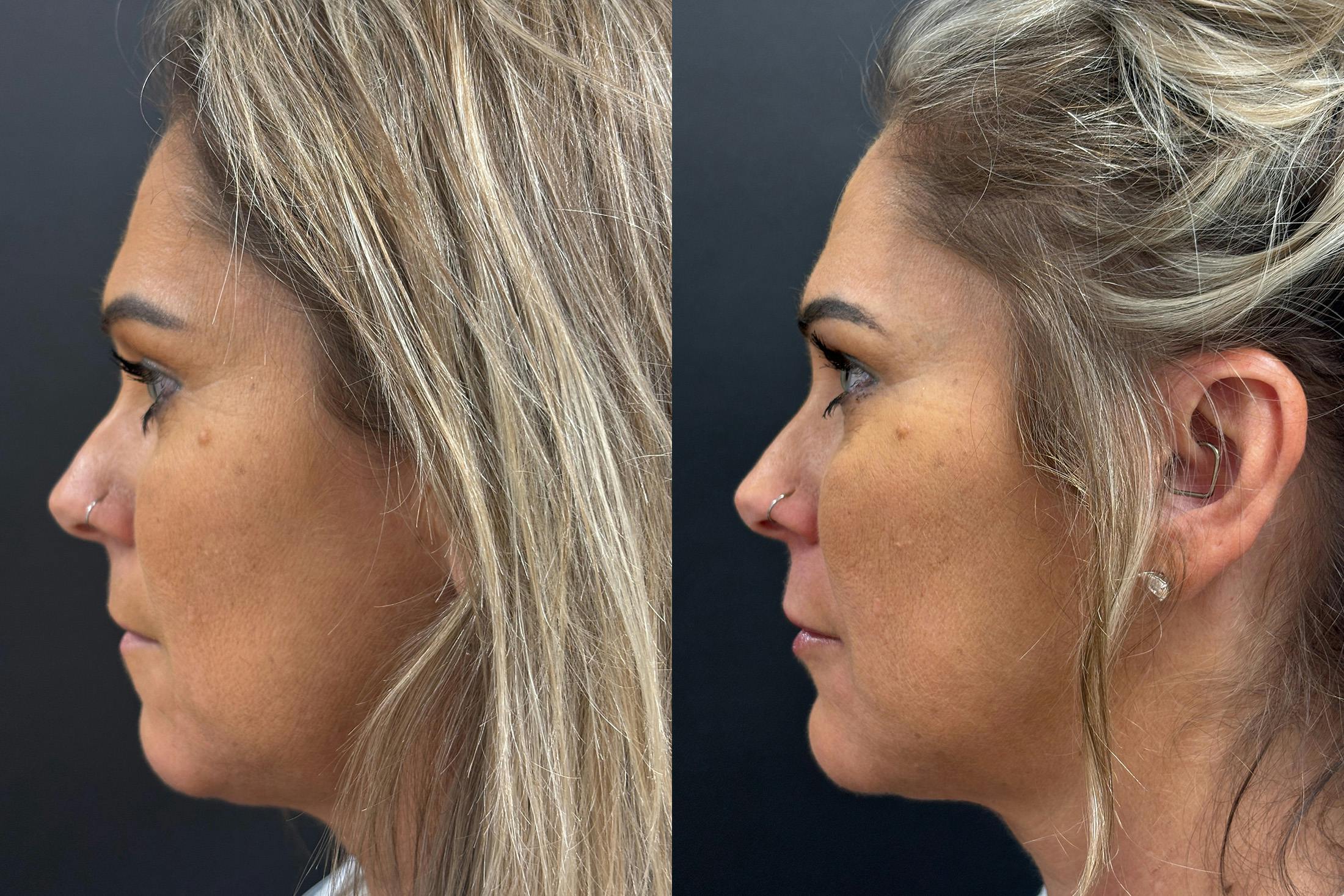 Dermal Fillers Before & After Gallery - Patient 397451 - Image 5