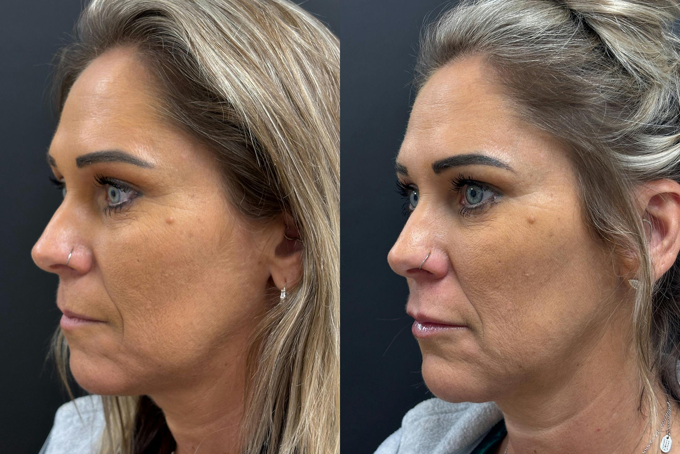 Dermal Fillers Before & After Gallery - Patient 397451 - Image 4