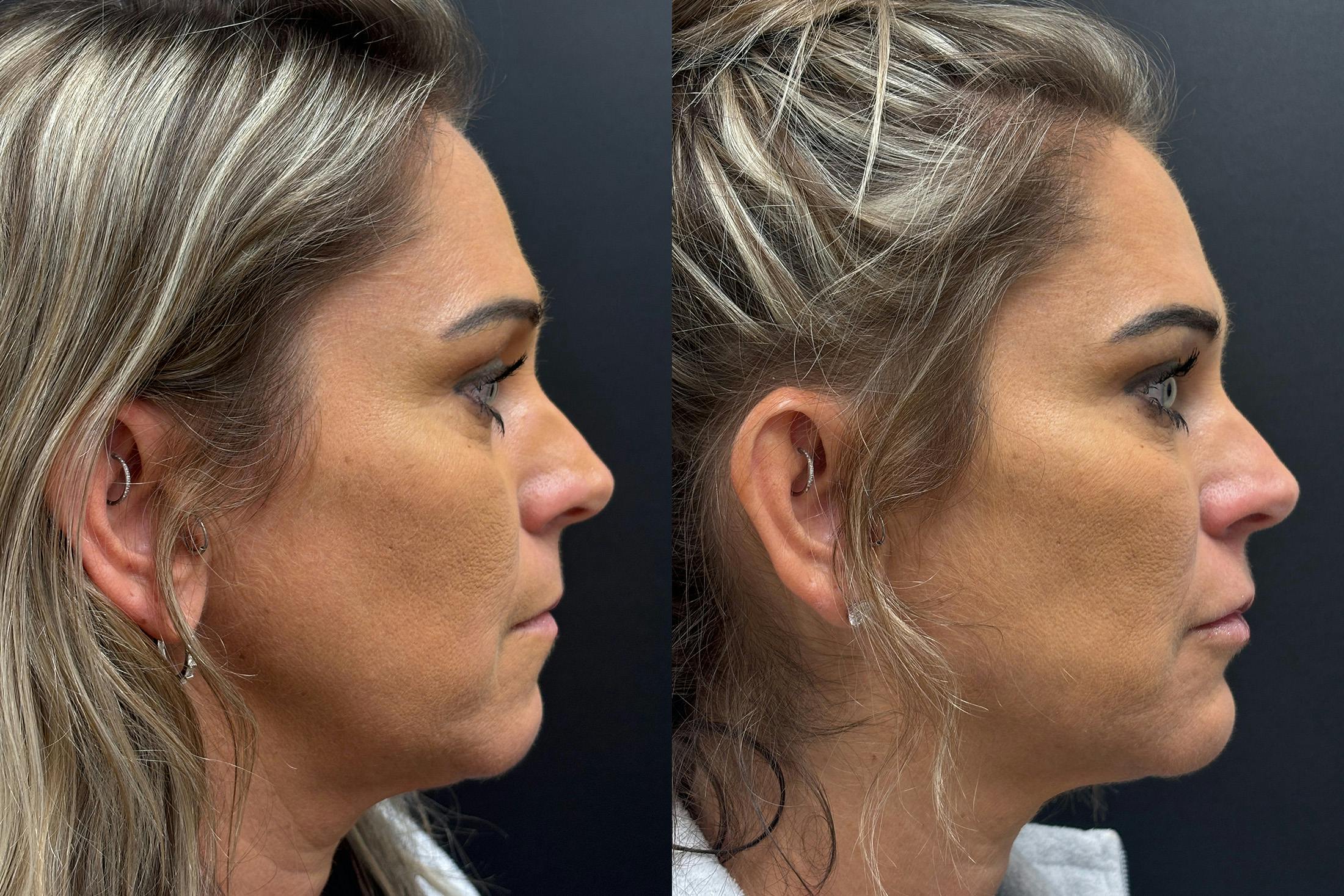 Dermal Fillers Before & After Gallery - Patient 397451 - Image 3