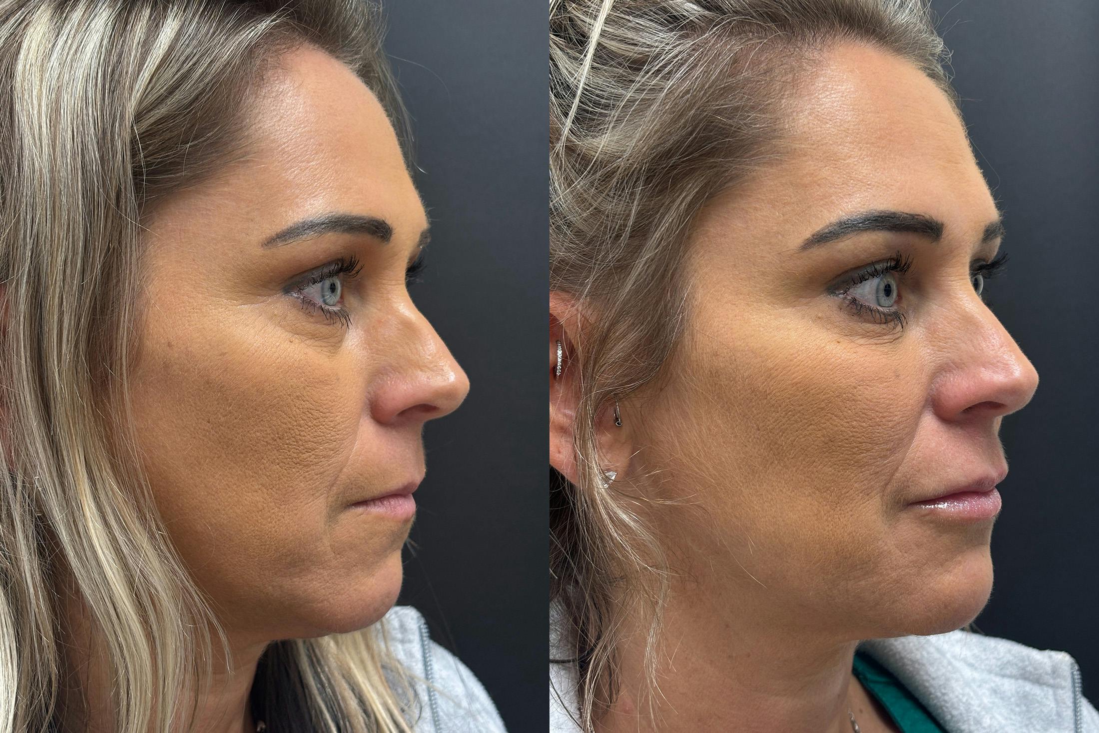 Dermal Fillers Before & After Gallery - Patient 397451 - Image 2