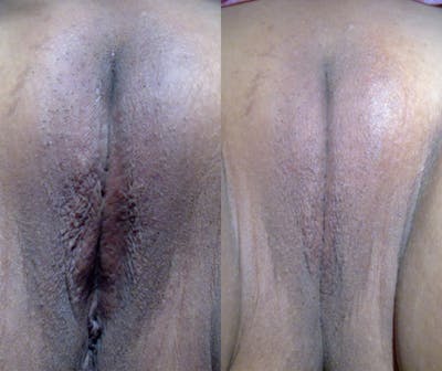 Votiva Before & After Gallery - Patient 354568 - Image 1