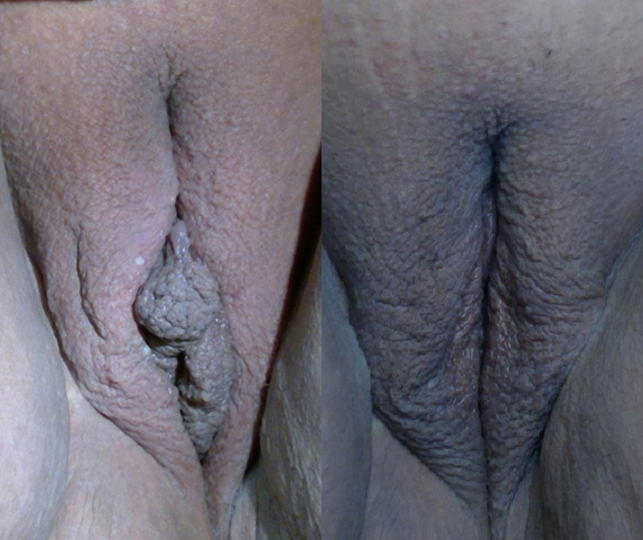 Labiaplasty Before & After Gallery - Patient 273675 - Image 1