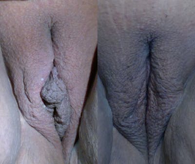 Labiaplasty Before & After Gallery - Patient 273675 - Image 1