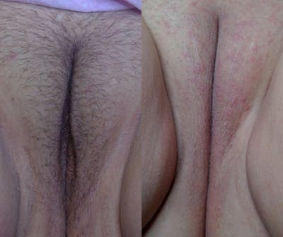 Votiva Before & After Gallery - Patient 176252 - Image 1