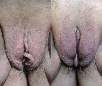 Votiva Before & After Gallery - Patient 160479 - Image 1