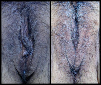 Aviva Before & After Gallery - Patient 610389 - Image 1