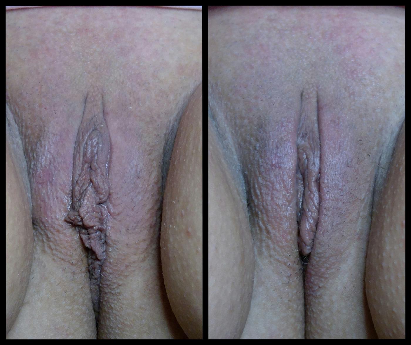 Morpheus8 V Before & After Gallery - Patient 809234 - Image 1
