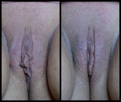 Morpheus8 V Before & After Gallery - Patient 809234 - Image 1