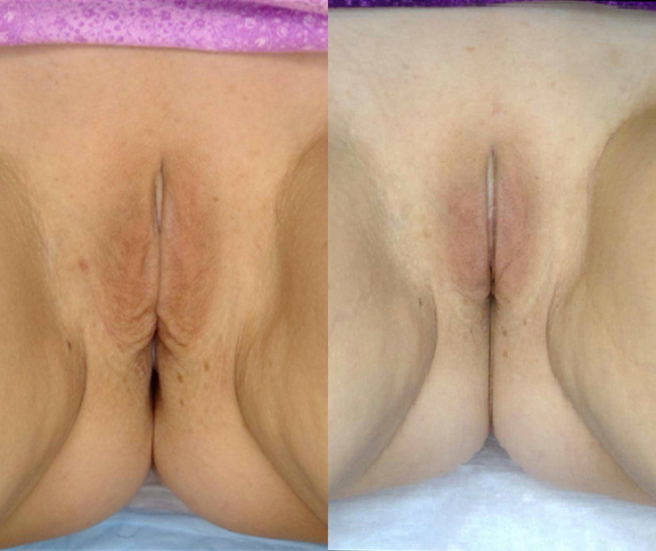 Votiva Before & After Gallery - Patient 348390 - Image 1