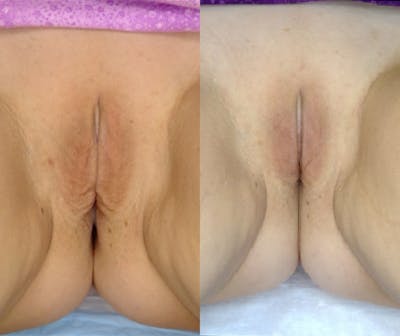 Votiva Before & After Gallery - Patient 348390 - Image 1