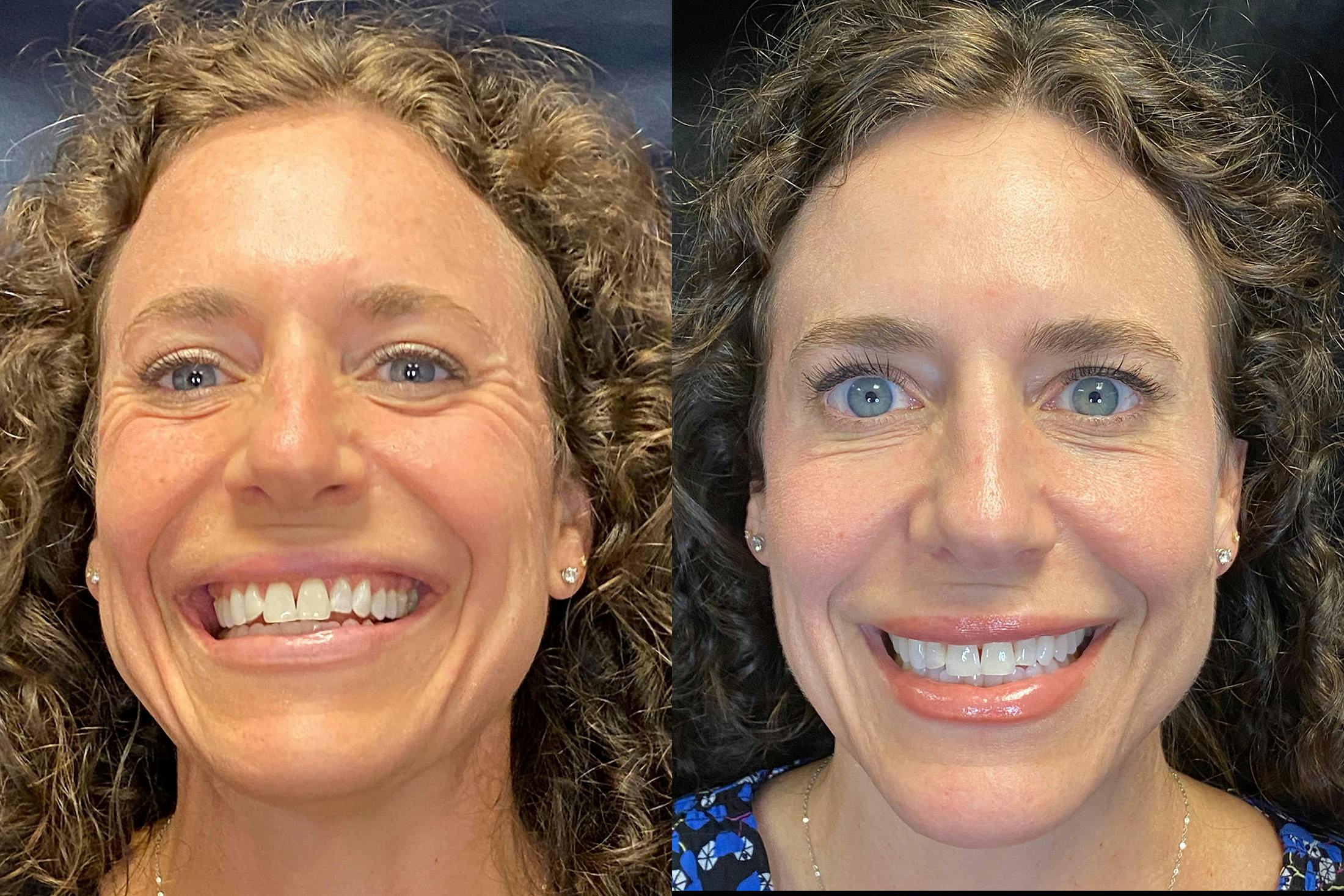 BOTOX/Dysport Before & After Gallery - Patient 340073 - Image 1