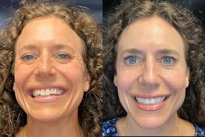BOTOX/Dysport Before & After Gallery - Patient 340073 - Image 1