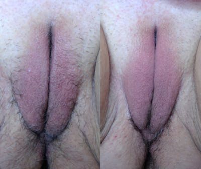 Morpheus8 V Before & After Gallery - Patient 814645 - Image 1