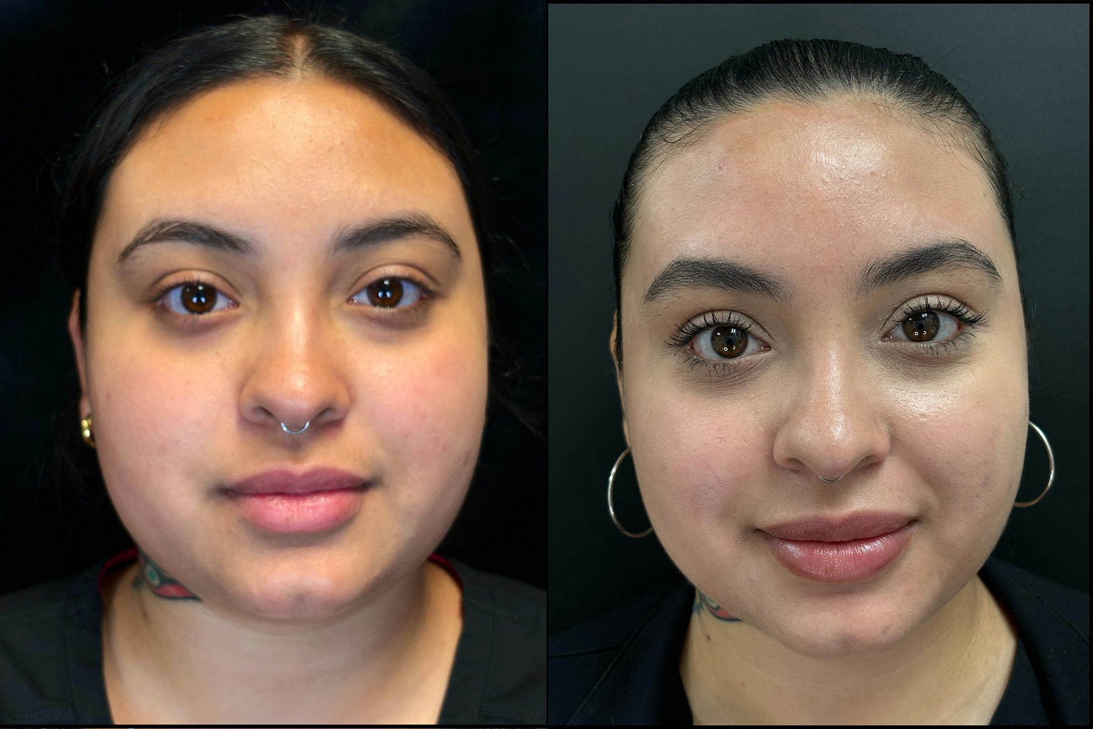 Evoke Before & After Gallery - Patient 422504 - Image 1