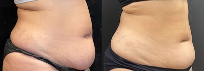 Weight Management Before & After Gallery - Patient 279308 - Image 1