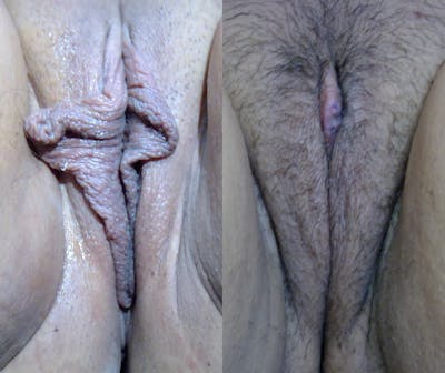 Labiaplasty Before & After Gallery - Patient 152174 - Image 1