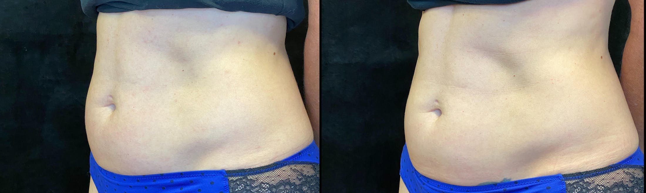 Weight Management Before & After Gallery - Patient 319094 - Image 2