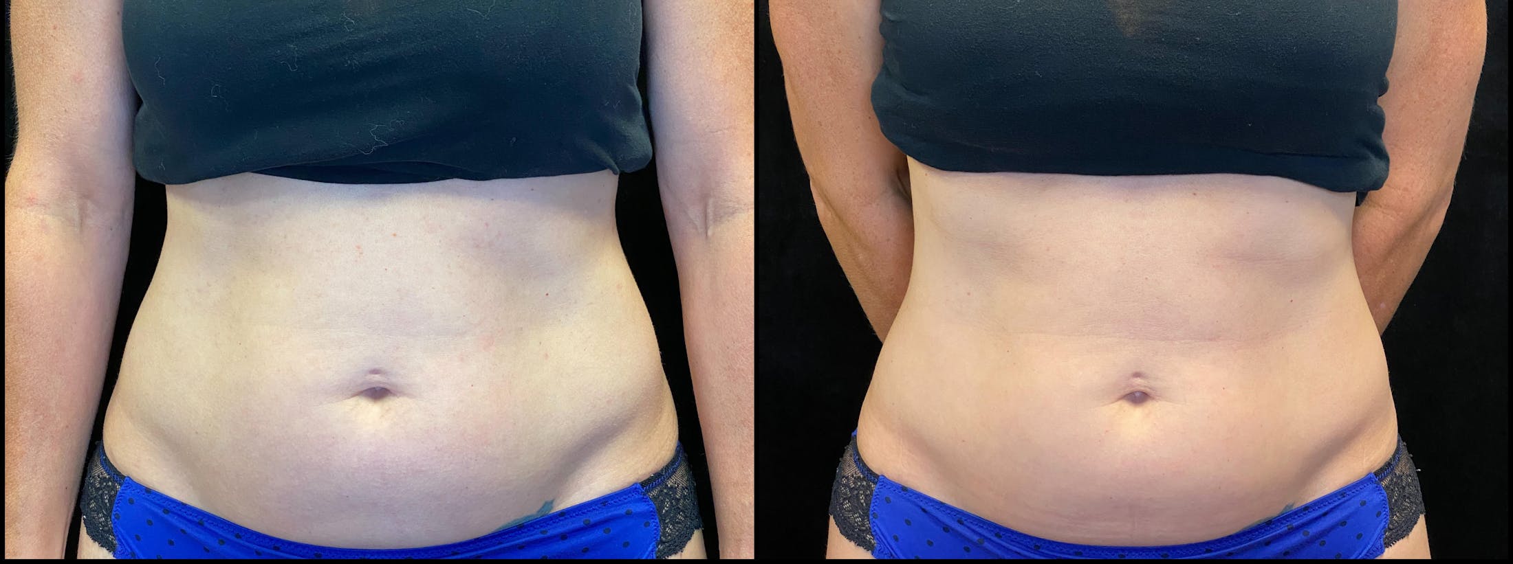 Weight Management Before & After Gallery - Patient 319094 - Image 1