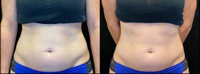 Weight Management Before & After Gallery - Patient 319094 - Image 1