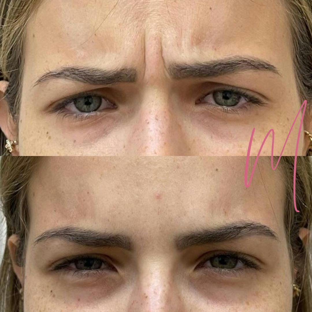 BOTOX/Dysport Before & After Gallery - Patient 158937 - Image 1