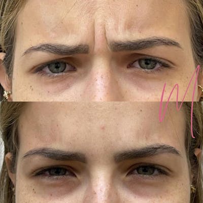 BOTOX/Dysport Before & After Gallery - Patient 158937 - Image 1