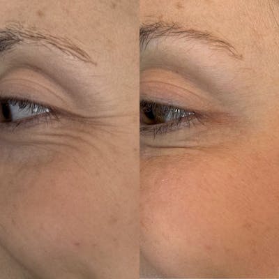 BOTOX/Dysport Before & After Gallery - Patient 428462 - Image 1