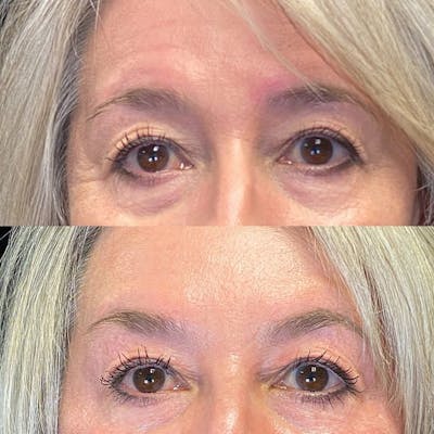 BOTOX/Dysport Before & After Gallery - Patient 179380 - Image 1