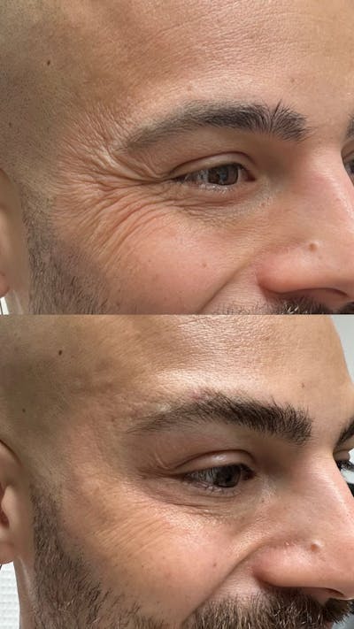BOTOX/Dysport Before & After Gallery - Patient 116572 - Image 1