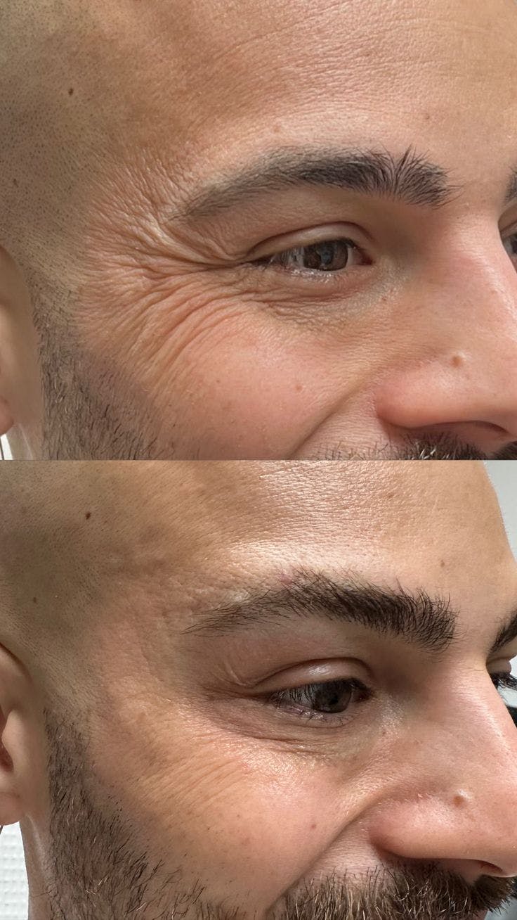 BOTOX/Dysport Before & After Gallery - Patient 116572 - Image 1
